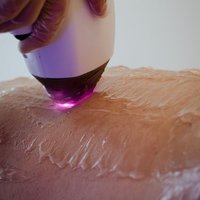 Depilación laser diodo (cavado + tiro de cola)