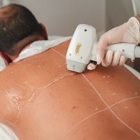 Depilación laser diodo (espalda)